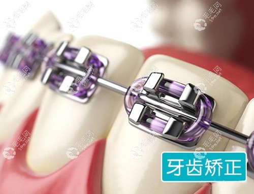 蘇州口腔醫(yī)院牙齒矯正報價
