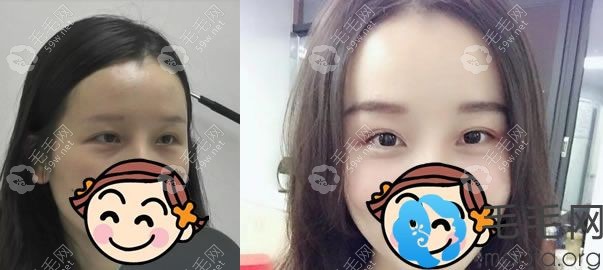 廣州華美植發(fā)郭鎮(zhèn)合植眉案例