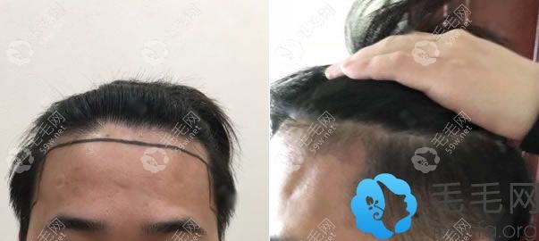 廣州華美醫(yī)院郭鎮(zhèn)合植發(fā)案例