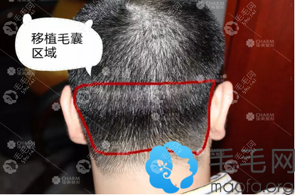 毛囊提取部位