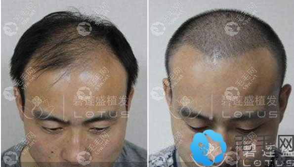 五级脱发植发前后效果对比图