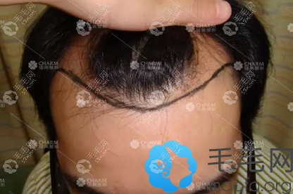 植發(fā)前設(shè)計