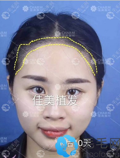 植發(fā)術(shù)后10天正面照