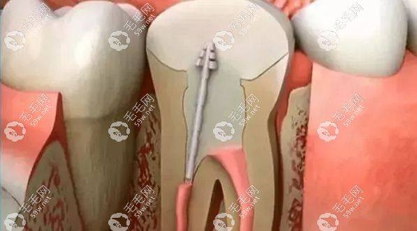 合肥牙齿根管治疗+补牙价格多少一颗