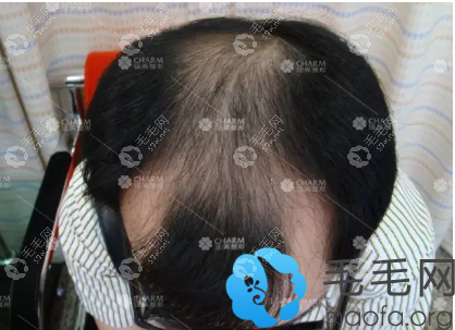 術(shù)前