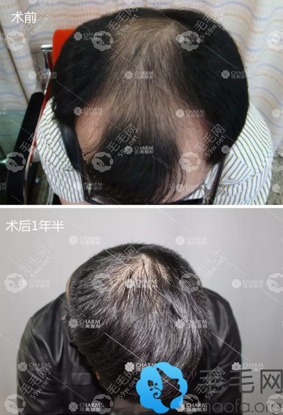 植發(fā)前后對比圖