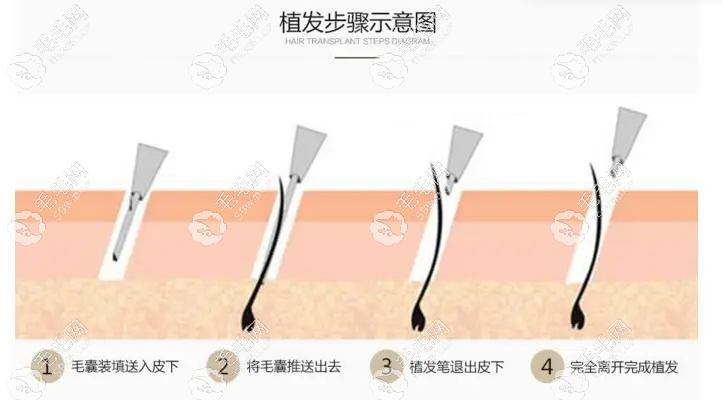 華美微針植發(fā)示意圖