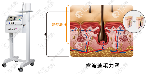 肯波迪毛力塑作用