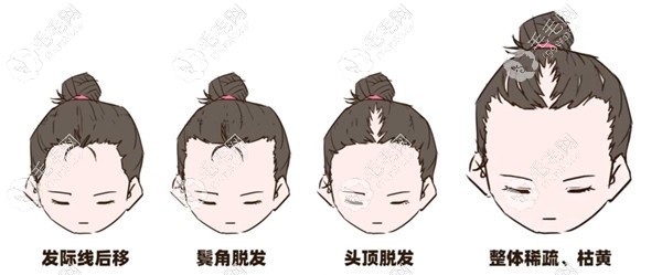 女性脂溢性脱发过程