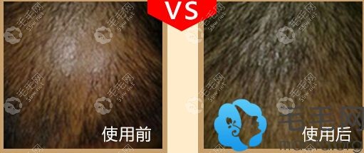 成都润禾毛发科艾威斯强能修复术效果