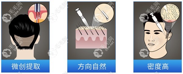 种植鬓角价钱贵吗？