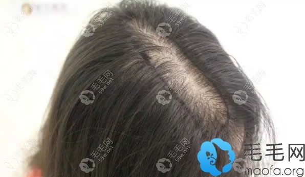 产后脱发图示