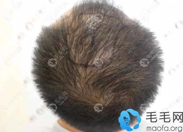 整体稀疏头发变少