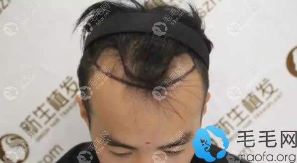 M型脱发图示