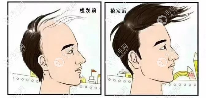 植发前后对比图