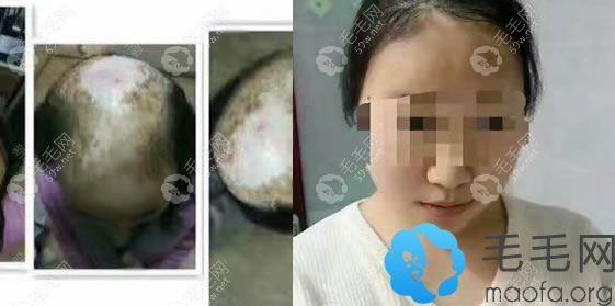 寧夏華美程宗玉疤痕植發(fā)案例