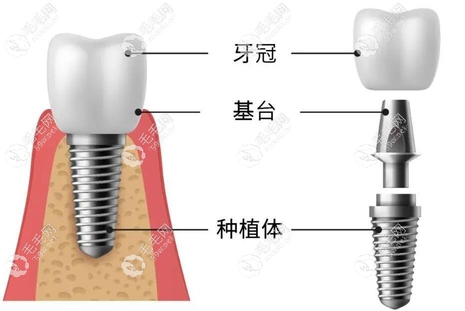 種植牙的構(gòu)造