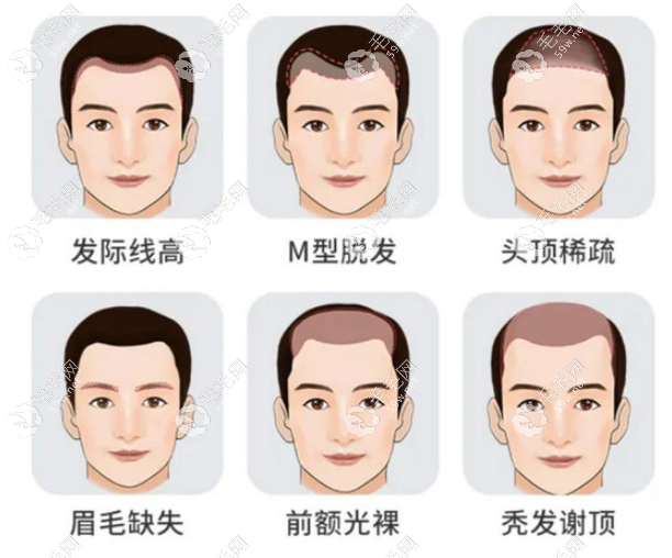 宜宾植发发际线的价格