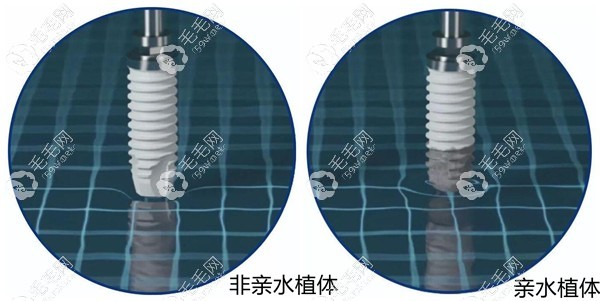 這親水種植體到底有什么優(yōu)勢