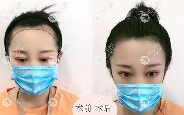 歐婷兒再生發(fā)際線(xiàn)案例效果