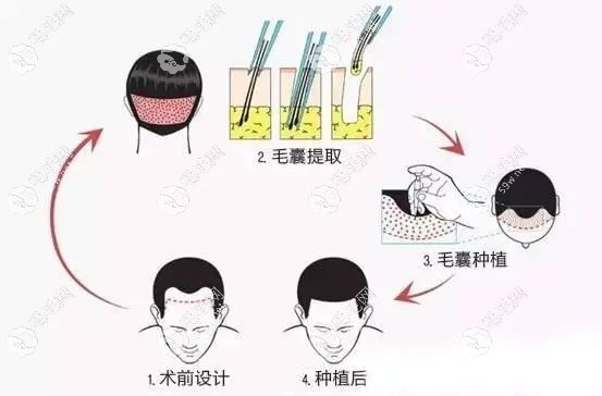 又細(xì)又軟的頭發(fā)怎么變粗？試試植發(fā)