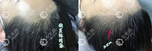 女士發(fā)際線(xiàn)再生真實(shí)案例效果