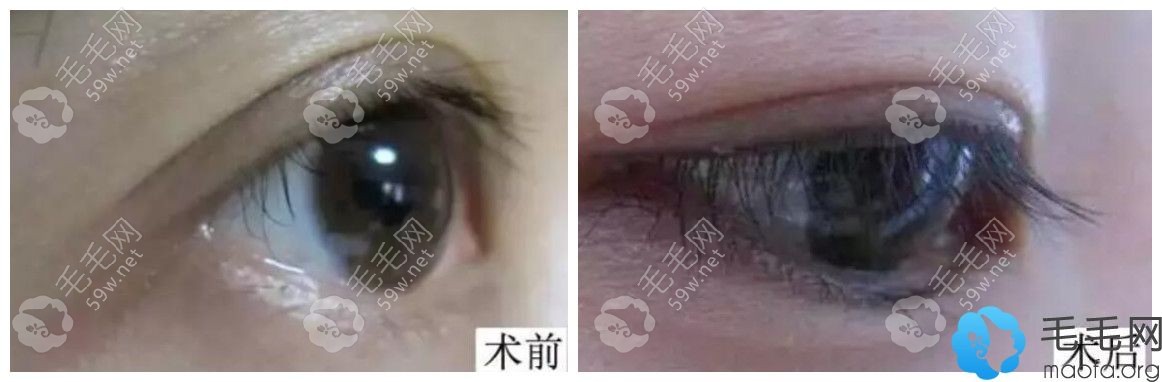 第二代FUE无痕植睫毛案例