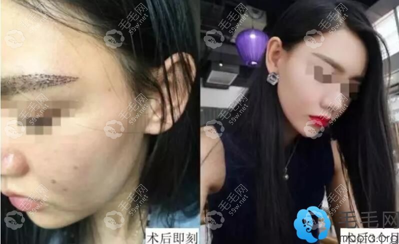 维多利亚无痕植眉案例