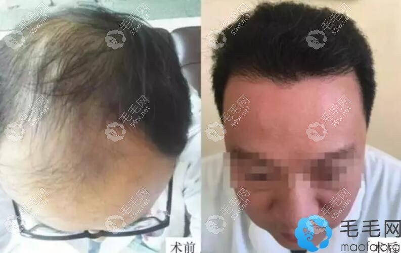 拉萨维多利亚第二代FUE无痕植发案例前后效果对比