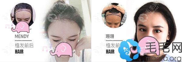 廣州荔醫(yī)植發(fā)際線案例效果