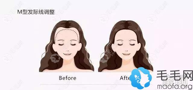 女生種發(fā)際線要多少錢?