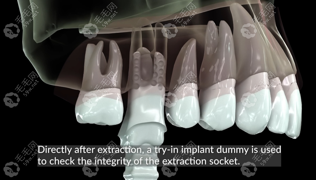 3d打印種植牙多少錢一顆