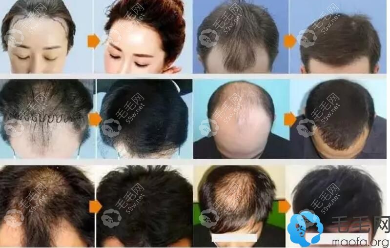 众多发友在拉萨维多利亚植发案例为其验证