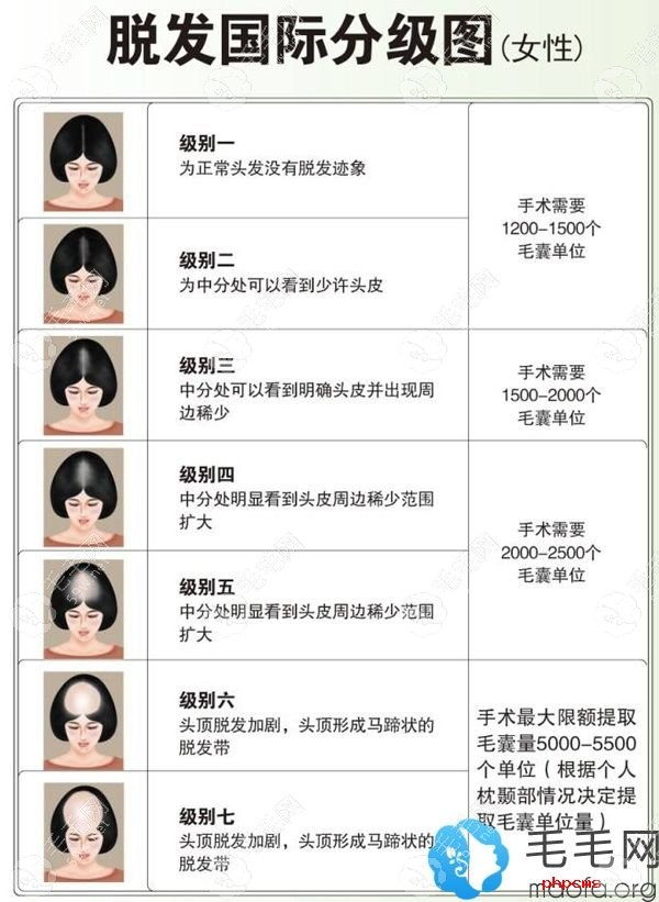 女生脫發(fā)等級(jí)圖以及需要種植的毛囊數(shù)量