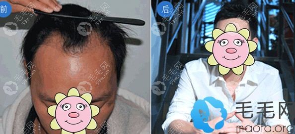 男明星植發(fā)案例