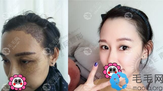 发际线和眉毛种植对比效果