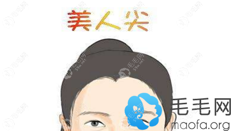 美人尖种植贵吗