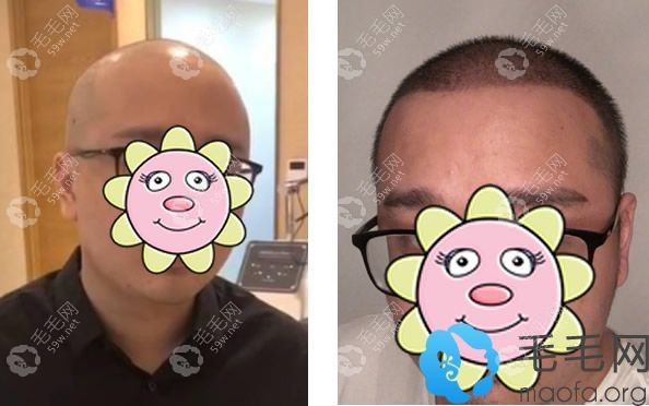 笑笑在杭州碧蓮盛植發(fā)效果