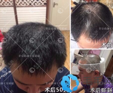 北京南加头顶加密种植术前术后效果