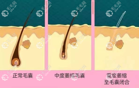 内分泌脱发症状有哪些www.59w.net