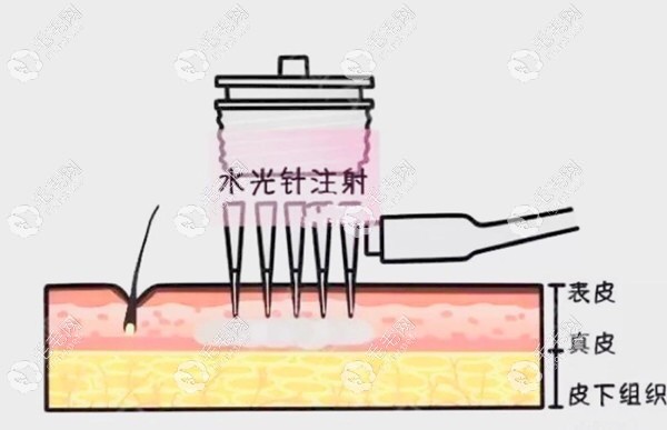 納米微針生發(fā)療法示意圖