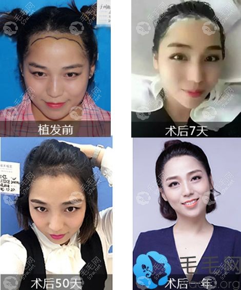 雍禾女士植發(fā)過程及效果