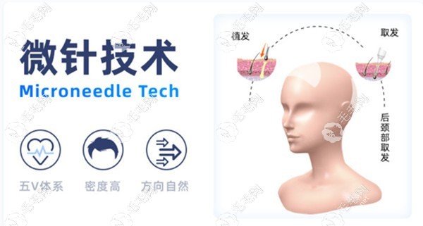 北京做微针植发比较好的医院排名
