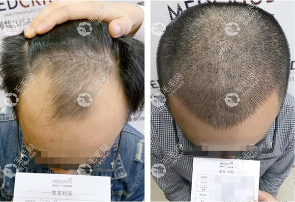 瑞丽美利丝植发效果图