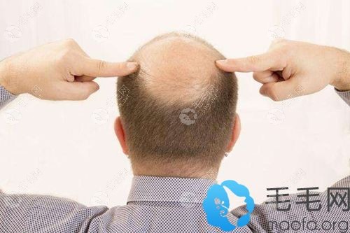 脱发趋势在与日俱增