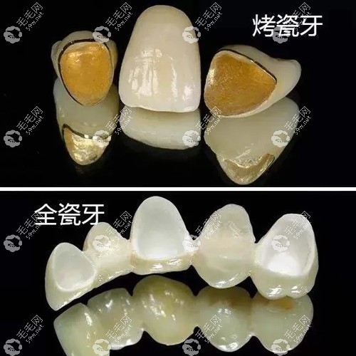 后牙戴牙冠做烤瓷牙還是全瓷牙好是看情況的www.053w.com