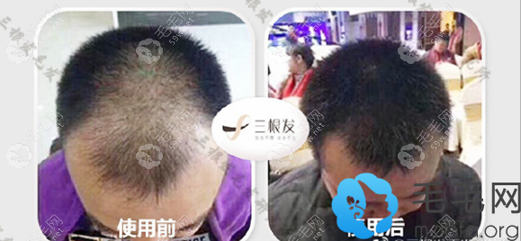 三根發(fā)生發(fā)液使用效果展示