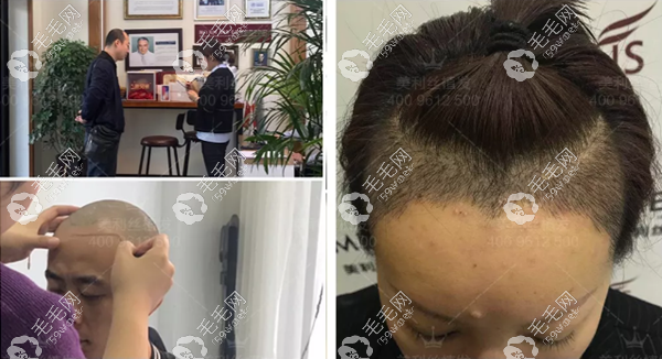 黑龙江瑞丽发际线种植效果图
