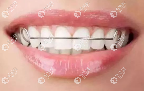 保持器兩三天不戴要緊嗎~毛毛網(wǎng)