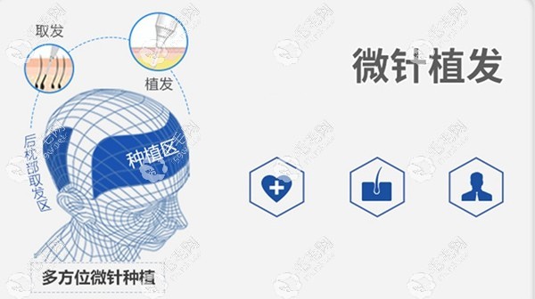 青丝亿利用微针植发技术